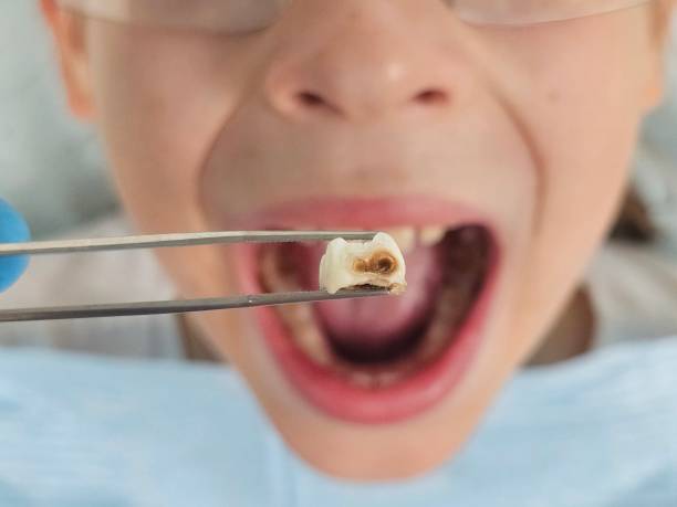 Best Emergency Dental Care for Abscessed Tooth in Chetek, WI